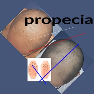 Générique de propecia